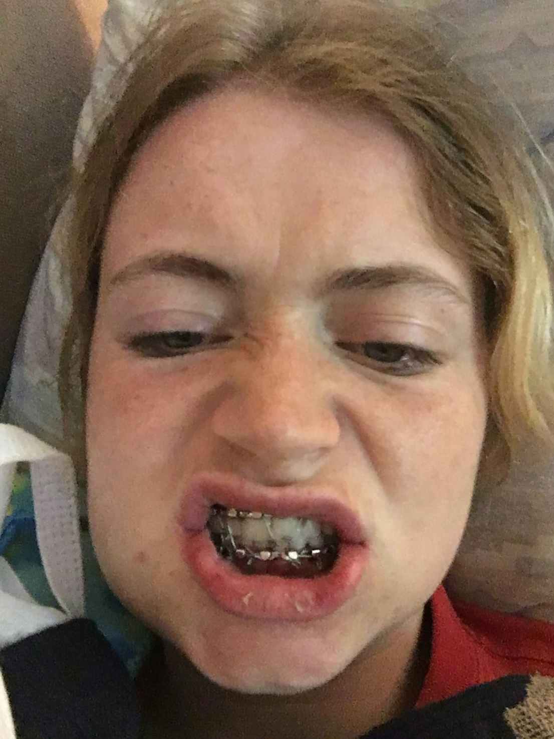 broken jaw wide mouth