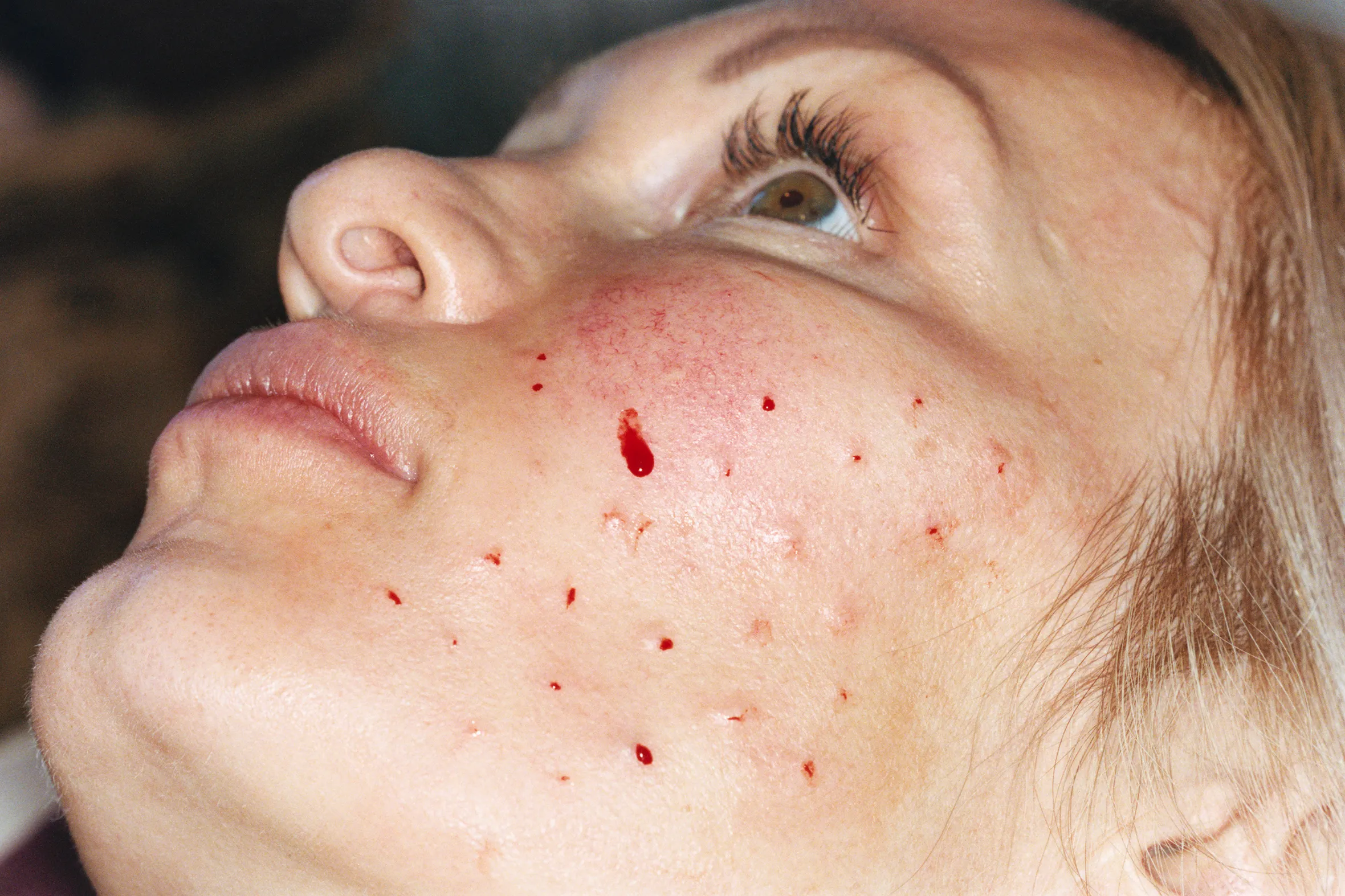 This is what 10+ years of Botox looks like - The Face